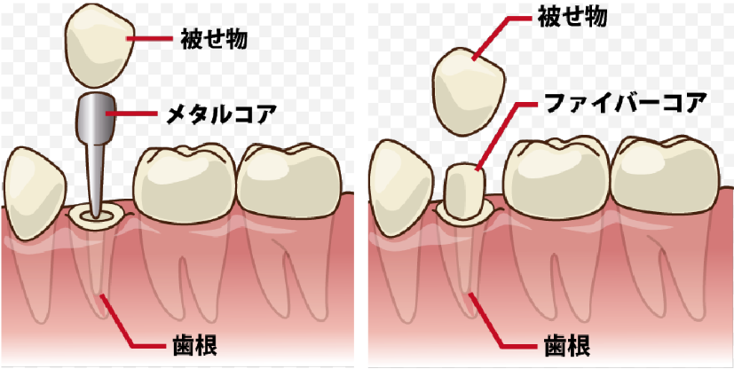 差し歯の構造